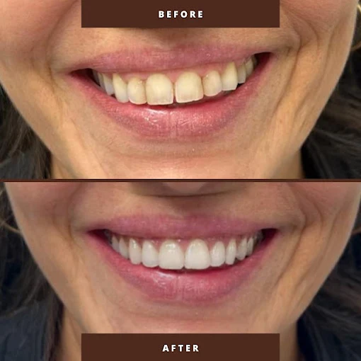 Antes e depois — Estética do sorriso