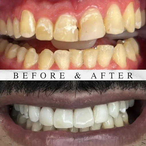 Antes e depois — Implantes & Prótese