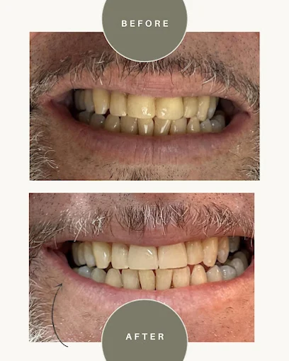 Antes e depois — Lentes de contato dental